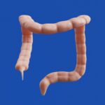 Sababu, Dalili na Tiba ya Vindonda Vya Tumbo (Ulcers)